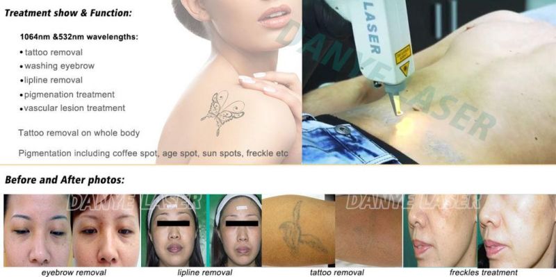 Stable and Competitive Portable Mini Q Switch YAG Laser Tattoo Removal /Age Spots Removal Machine