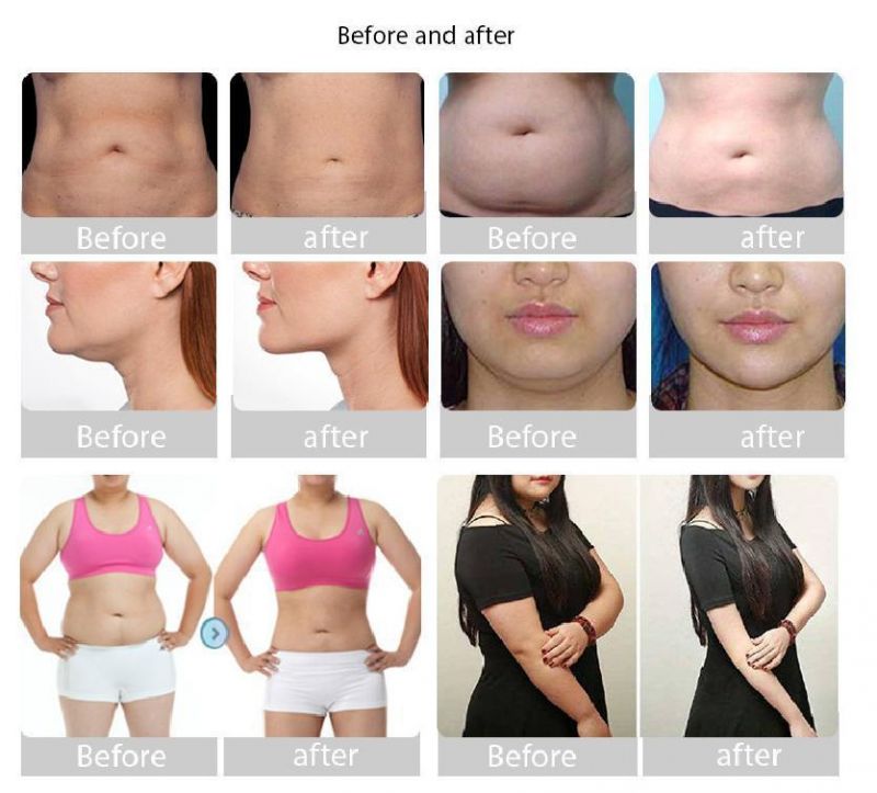 80krf Cavitation Lipo Laser Freeze Fat Removalchin Cryolipolysis 360cryo