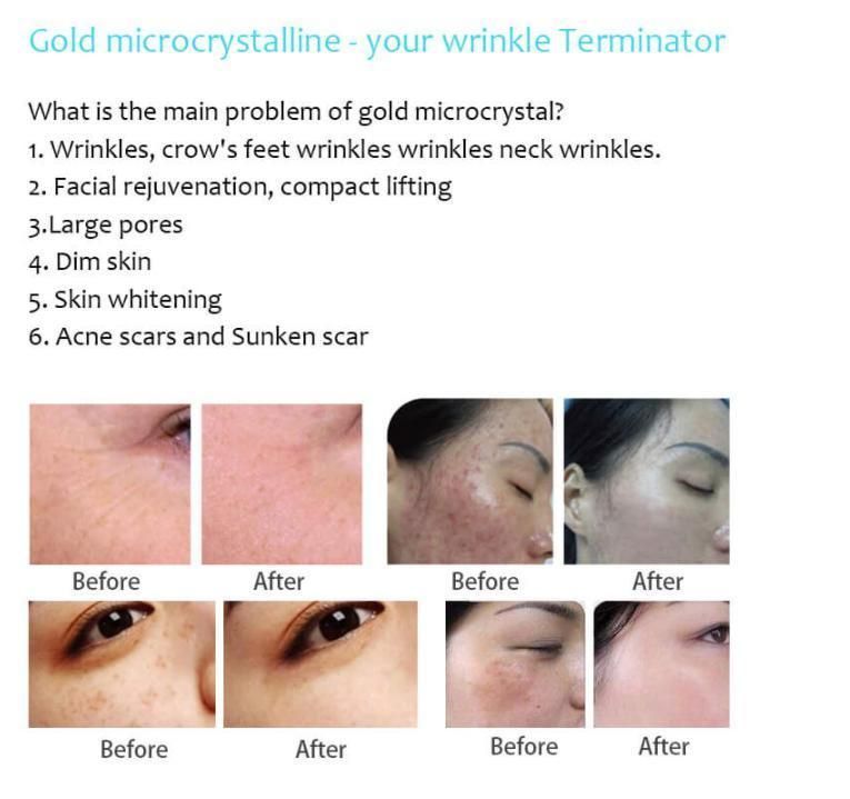 Fractional Microneedling Skin Care RF Machine for Medical Equipment Acne Scar Stretch Marks Removal