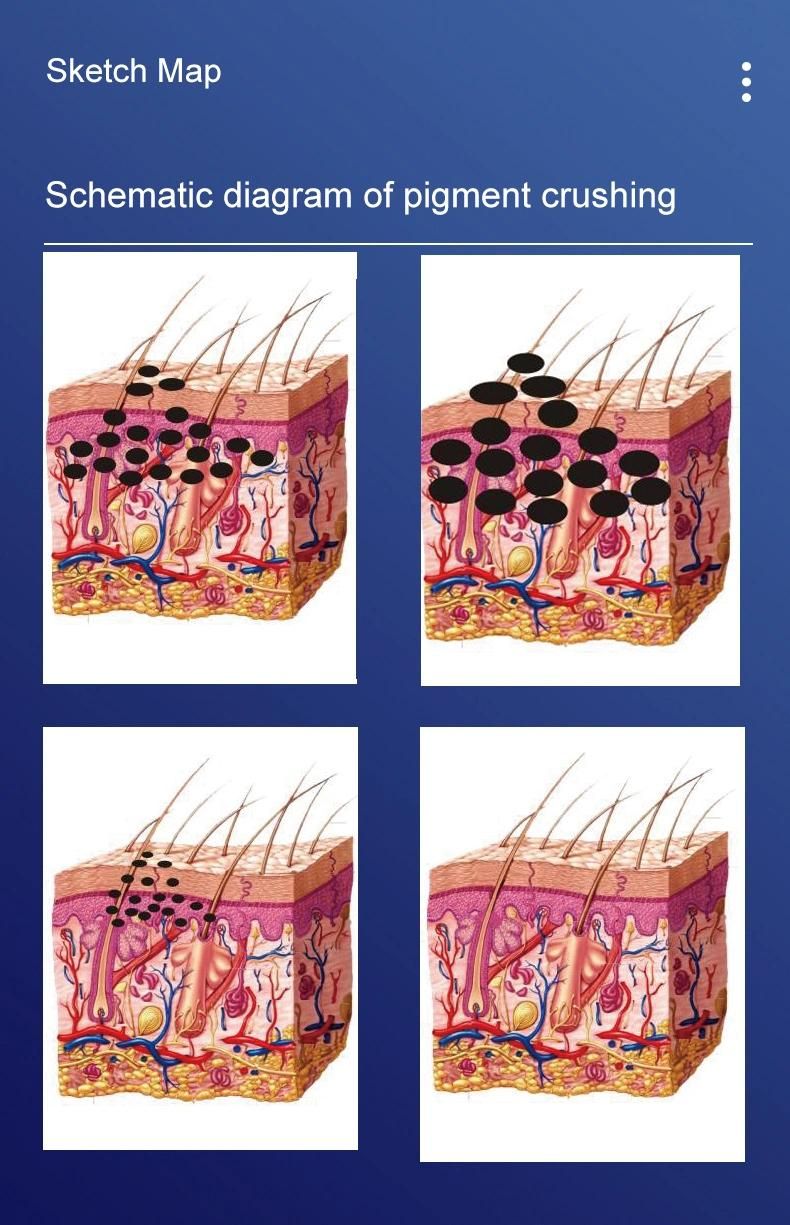 Picolaser Dark Spot Removing Tattoo Acne Removal Q Switched ND YAG Laser Picosecond Laser