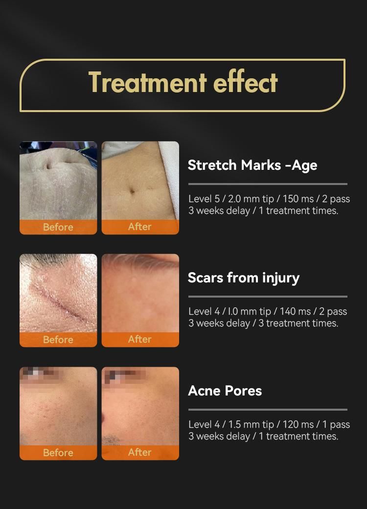 Vacuum Acne Removal RF Skin Care Beauty