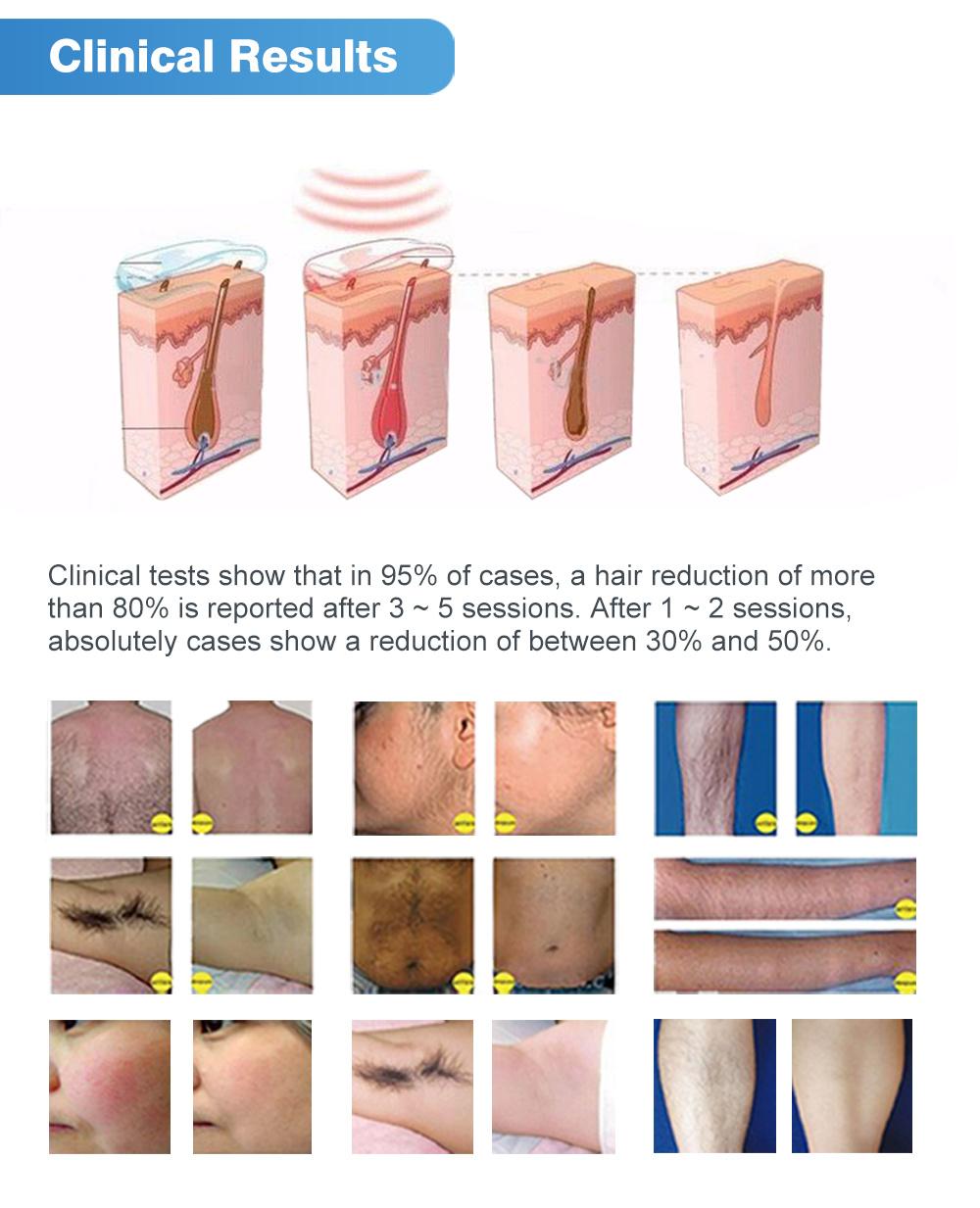 Hair Reduction Diode Ice Laser Hair Removal Device 808nm Laser Machine High Quality CE