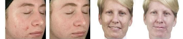 on Sale Water Oxygen Jet Peeling Hydro Facial Dermabrasion Face Cleaning Skin Analyzer Hydrafacials