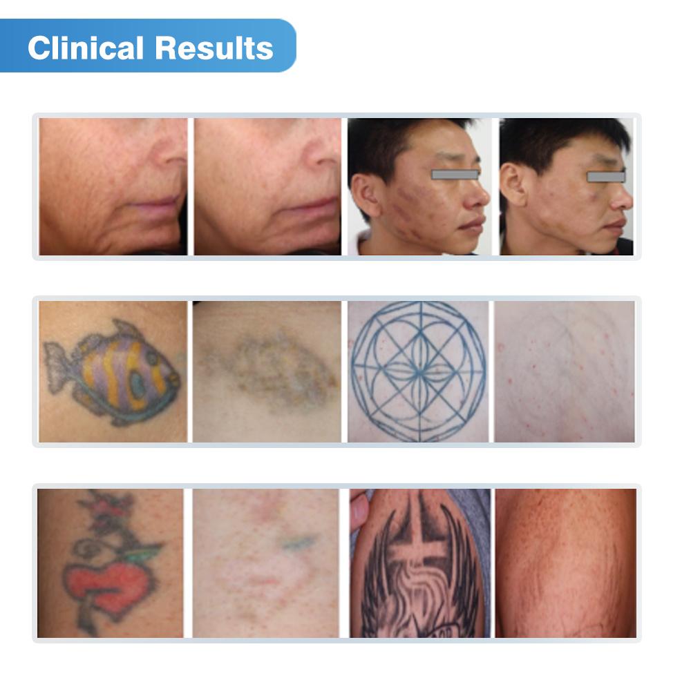 Tattoo Removal Machine Treatment of Blood Vessels Bw-192 Laser Tattoo Removal Machine Price