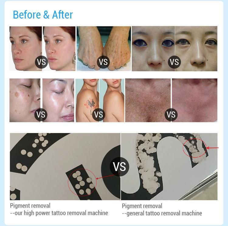 Beauty Laser Tattoo Removal ND YAG Laser 1064nm 532nm 1320nm