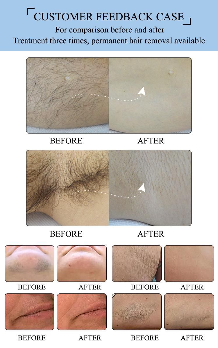 Professional Germany Bars Diode Laser/Laser Diodo 808/Hair Removal Laser