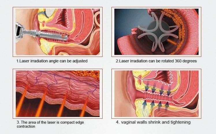 Stationary Laser Equipment CO2 Fractional for Vaginal Tightening, Acne Scar Removal