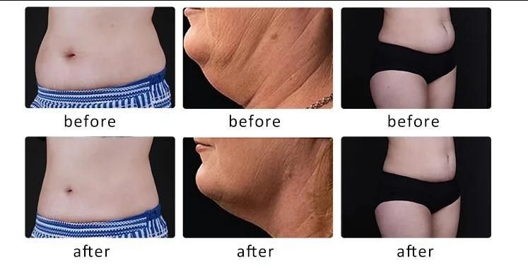 Non-Invasive Treatment Fat Loss Slimming Machine