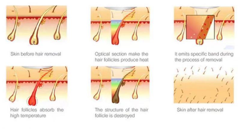 M Laser Diode Remove Hair 3 Wavelength