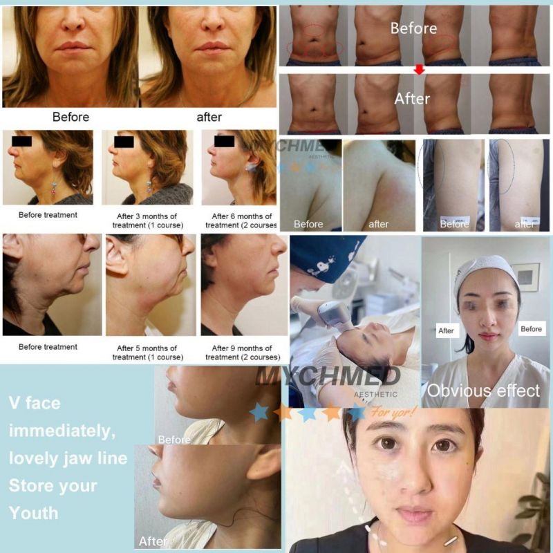 Face Lift Wrinkle Remover Skin Tightening 7PCS Cartridges Body Shape Slimming 7D Hifu Beauty Machine