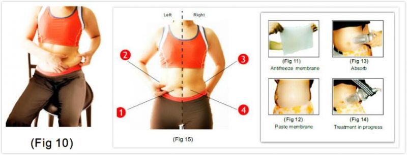 RF+Fat Freeze+Vacuum+Laser+Cold Light Cryolipolysis System Equipment (CRV6)