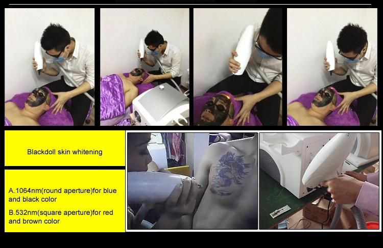 Portable ND YAG Laser Machine for Tattoo Removal