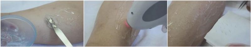 Noblelaser Laser Hair Removal Machine /Fiber Coupled Diode Laser