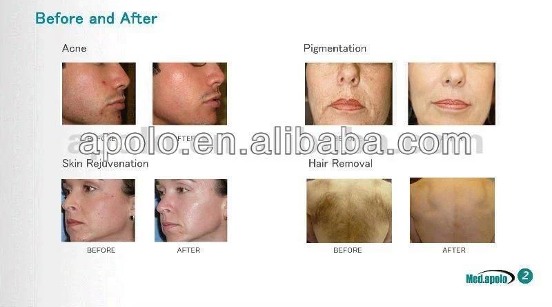 Shanghai apolo ce approved ipl elight laser facial treatment for acne scar