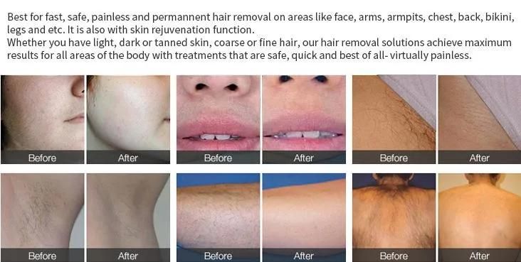 V-Hair Removal Permanent Effective Skin Rejuvenation Vertical Beauty Equipment