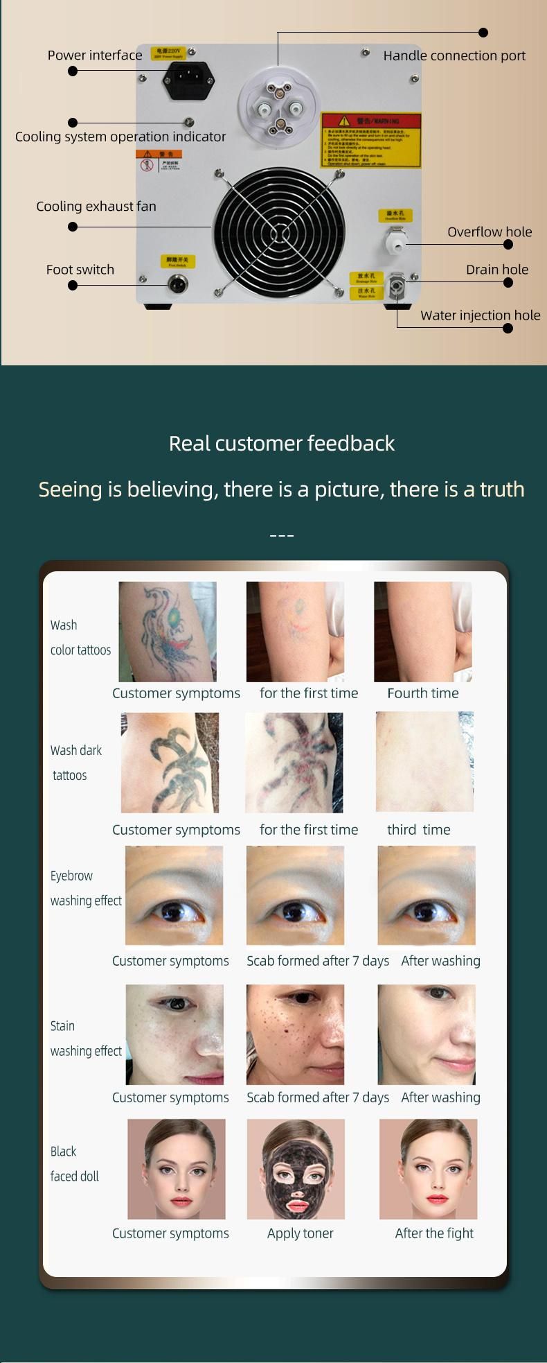 ND YAG Laser Tattoo Removal Eyebrow Wash Spot Removal Beauty