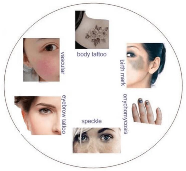 Professional Q-Switched ND YAG Laser Tattoo Removal Machine Beauty Salon Equipment