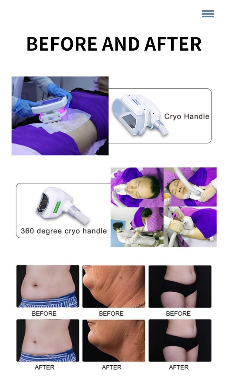 360 Degree Cryolipolysis Fat Freeze Body Slimming Machine with Five Technologies
