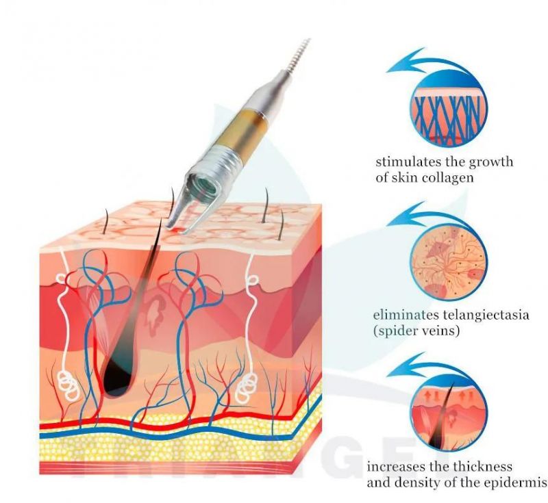 980nm 532nm Laser Vascular Removal Machine Spider Veins Vascular Machine