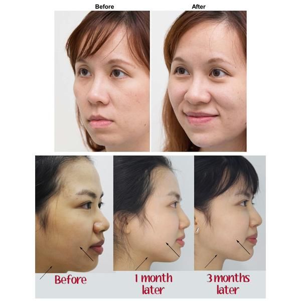 2 in 1 Intensity Focused Ultrasound V Max Hifu 4D for Face Lift