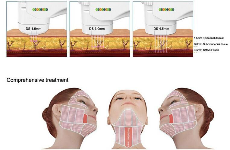 Hifu Portable Focused Ultrasound Beauty Machine for Skin Tightening (Fu4.5-3s)