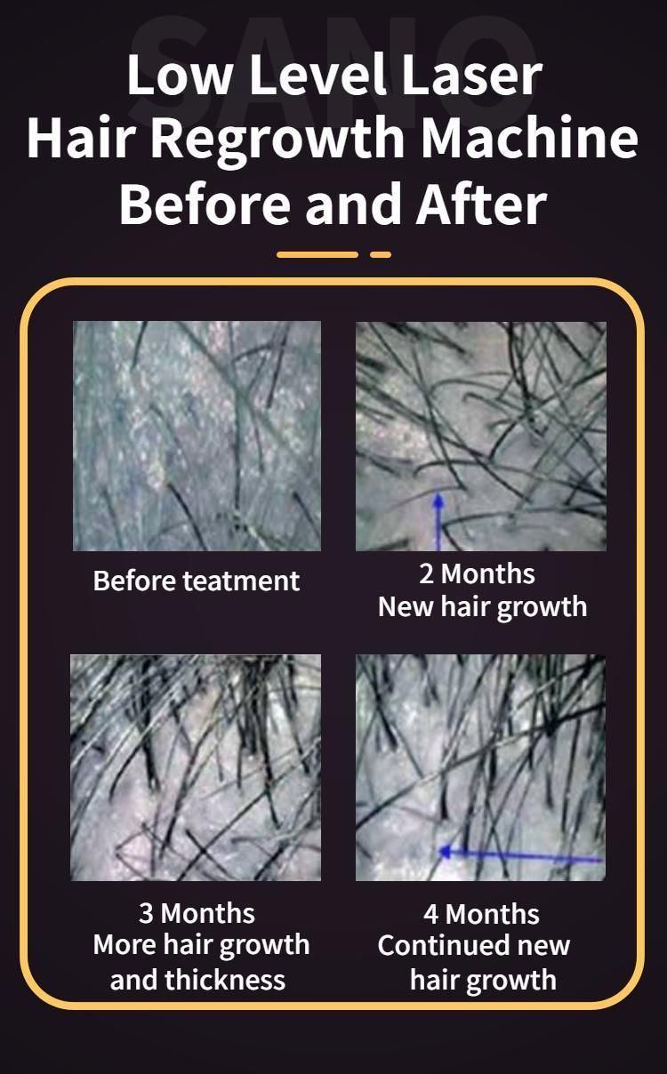 Laser Hair Growth Regrowth Machine Hair Restoration Machine