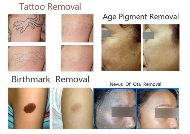 switched laser tattoo removal machine HS 250 depigmentation treatment lighten dark spots by shanghai med apolo