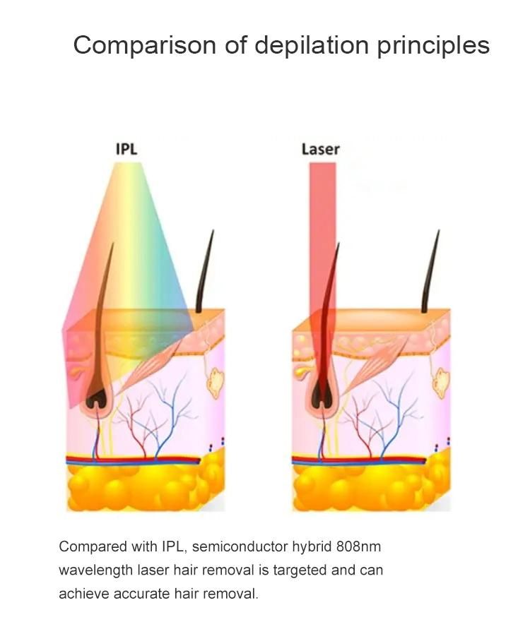 Diode Laser 808nm for Hair Removal and Depilation 808nm Diode Laser for Permanent Hair Removal Beauty Machine