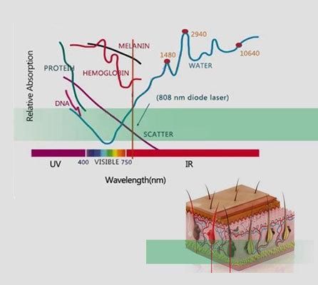 808nm Diode Laser Body Hair Removal