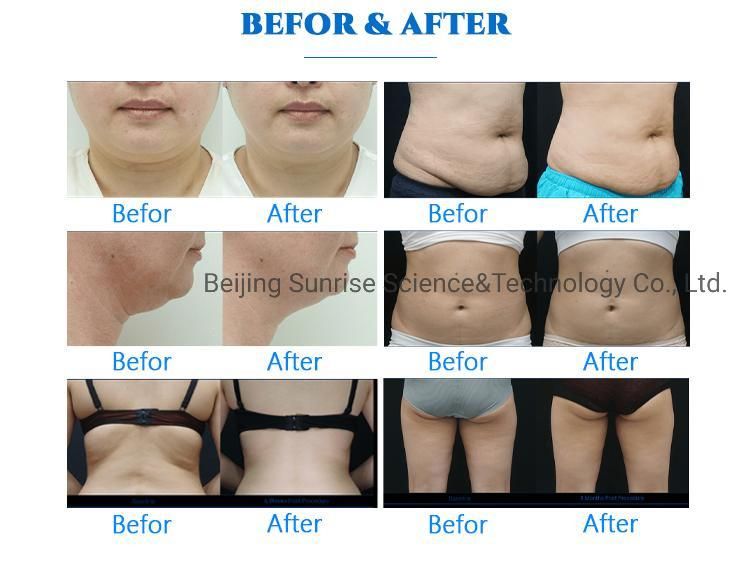 Best 360 Cryolipolysis Slimming Cooling Skin Tightening Cryo Fat Freeze Machine Body Slimming Cryotherapy