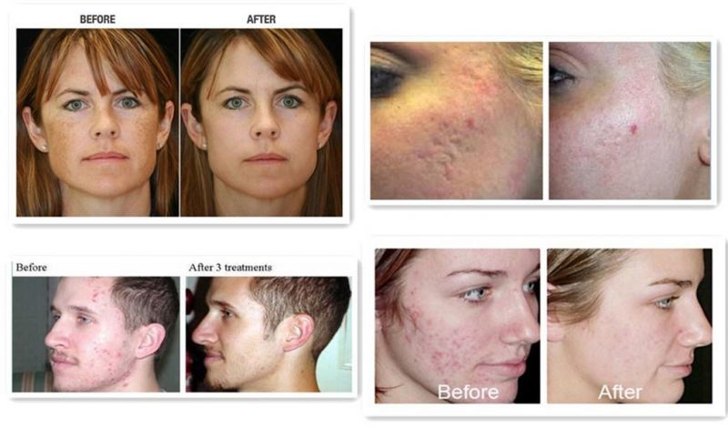 Fractional CO2 Laser Resolve Skin Problem Beauty Equipment