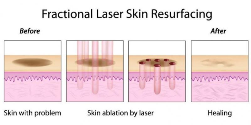 Fractional CO2 Laser Resolve Skin Problem Beauty Equipment