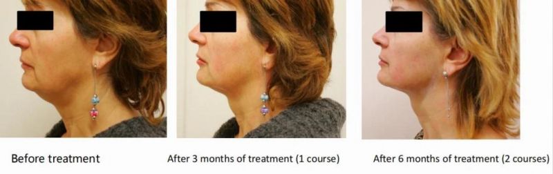Professional 7D Hifu Ultrasonic Beauty Salon Equipment for Face Lifting Skintightening Anti-Wrinkle Anti-Aging