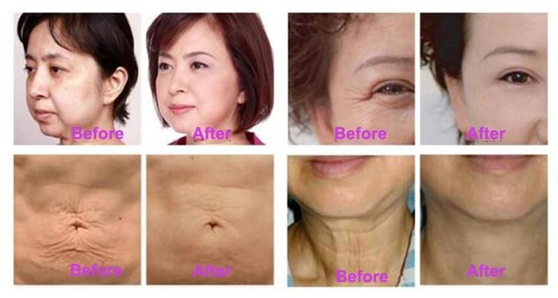 Professional Cet Ret Monopolar RF Skin Tightening Beauty Equipment