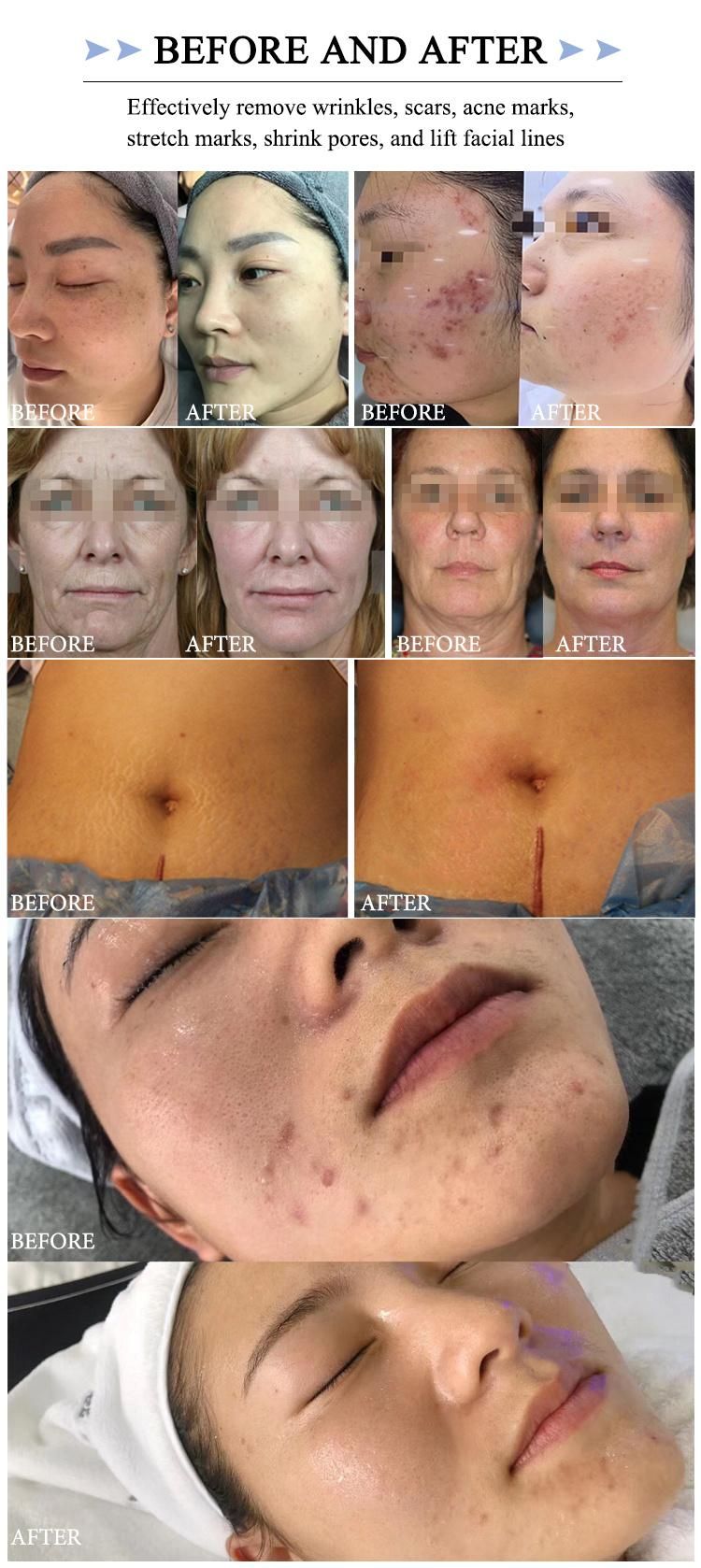 RF for Body and Face Skin Tightening with Fractional RF Microneedle Machine