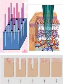 Fractional CO2 Laser Ultrapulse