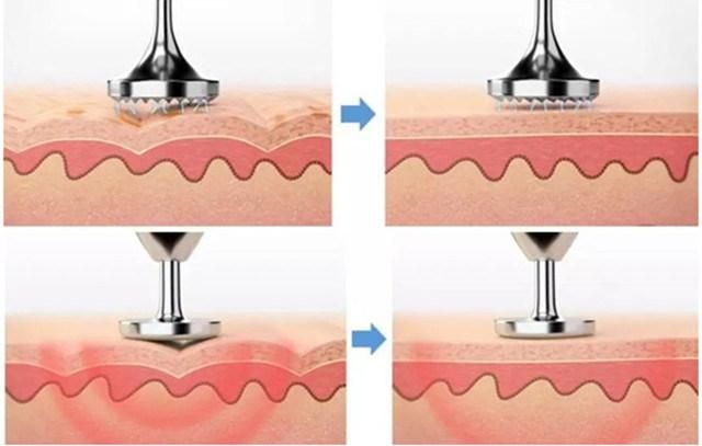 Handheld Spot Removal Skin Lifting Monstey Plasma Pen