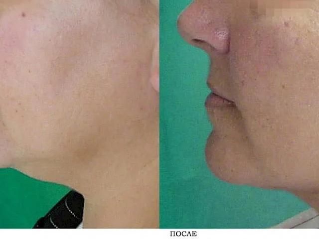 Skin Firming Lifting Fat Reduction Liposuction Skin Tighten Latest Facial Sculpting Non Surgical Highly Effective Laser 1470nm