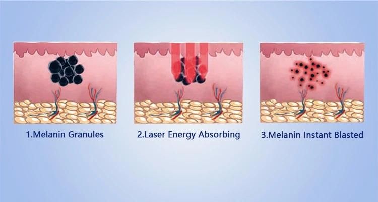 Q Switched ND YAG Ndyag Laser for Tattoo Removal Skin Whitening Rejuvenation Carbon Peeling Machine