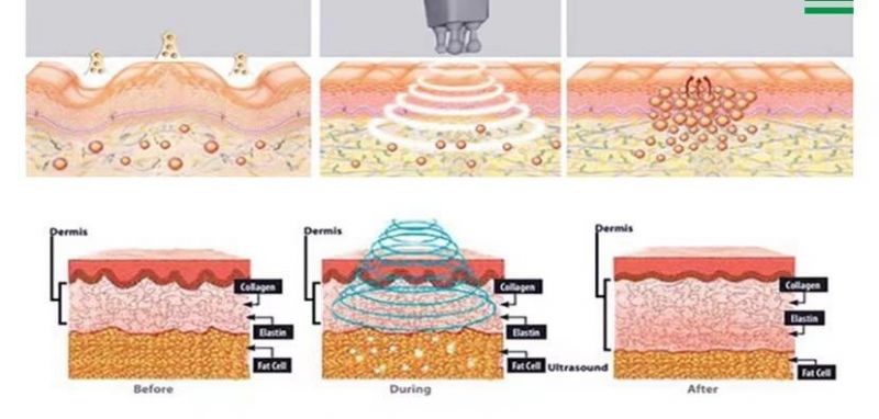 M-Fat Removal Skin Tightening RF Promotes Metabolism Cavitation