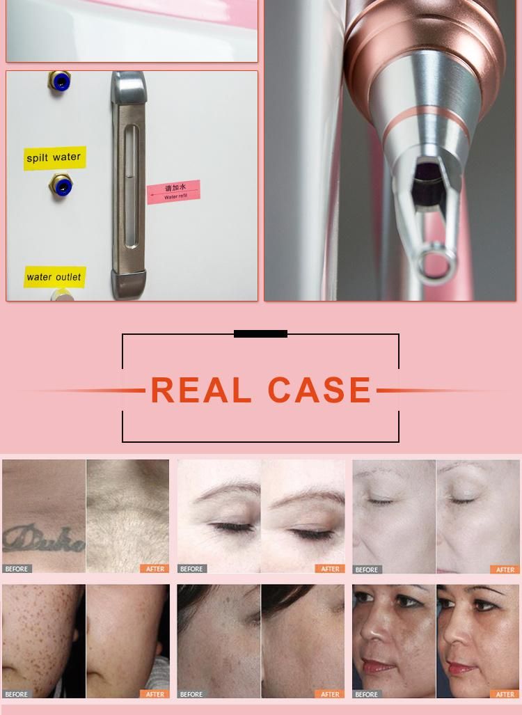 Sun Spot Remove Pico Laser Shr Elight Hair Removal RF Wrinkle Removal Machine