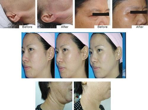 Skin Lifting RF Wrinkle Removal Beauty Machine