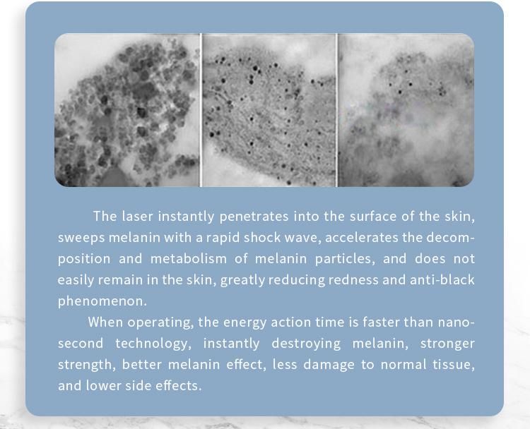 Picosecond Chloasmas Removal Pico Laser