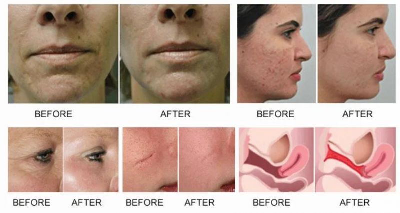 Multifunction Laser Beauty Equipment Professional CO2 Laser Fractional Laser Machine Removal Scars, Acne Scars Freckles