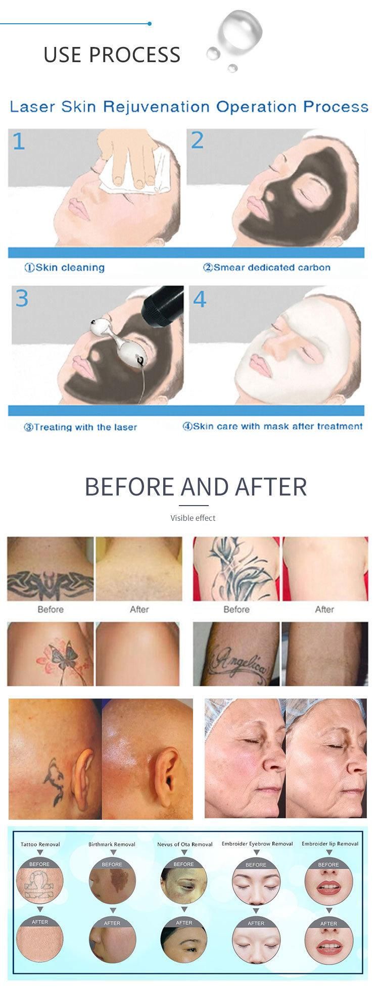 Picosecond Laser Tattoo Removal Machine Laser Picosecond Picotech Laser