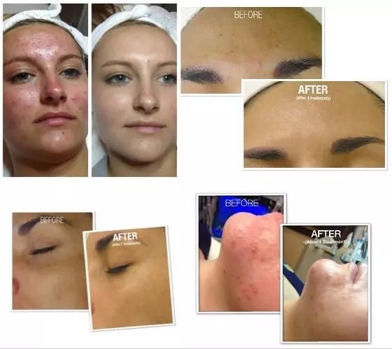 Sincoheren SPA PDT Skin Aqua Facial Hydro Dermabrasion Facial Machine for Skin Rejuvenation