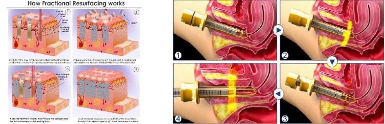 China Best Medical CE Approved CO2 Fractional Laser Surgery Equipment for Skin Tightening