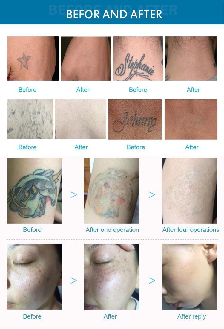 Carbon Peel Tattoo Removal Laser Machine ND YAG Laser