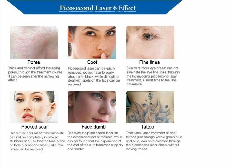 Tattoo Pico Laser Removal Picosecond 755 Machine