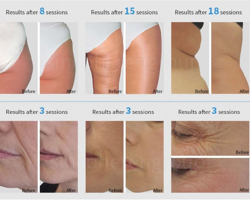 30% off Endoroller Body Slimming Contouring Endo Facial Lifting Wrinkles Remove Endo Roller